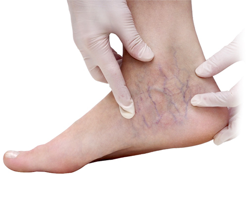 Have some knowledge on the varicose veins
